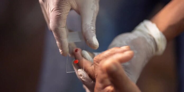 SUS começa a usar novo tratamento contra a malária em crianças